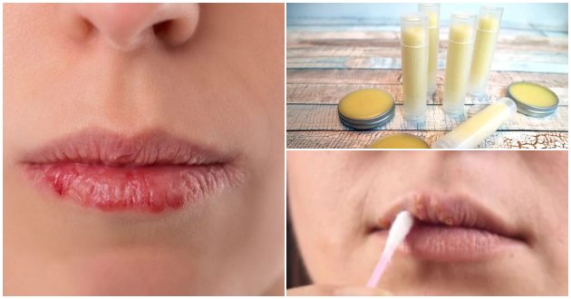 how-to-get-rid-of-oral-herpes-healthylifestyle